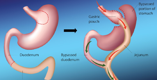 roux en y gastric bypass anatomy